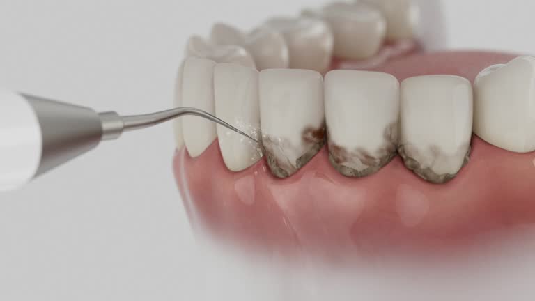 Trusted Dental Crowns And Bridges service in Prunedale, CA - Dentist Open Now